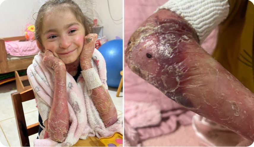 Isabela, criança de 9 anos com epidermólise bolhosa, em tratamento contínuo
